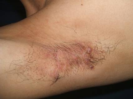術後２ヶ月、ひきつれが解消し、皮膚の色もほぼ正常になって、傷跡もほとんど目立たない