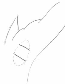 点線の範囲に充分な局所麻酔を注射後腋の下に上の図のように1ないし2箇所の切開をおきます。