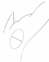 腋毛の範囲が縦長の場合には切開が２箇所となることがあります。通常は１箇所で行います。